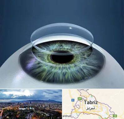 پیوند قرنیه در تبریز