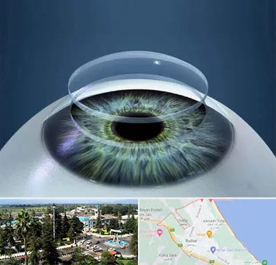 پیوند قرنیه در رودسر