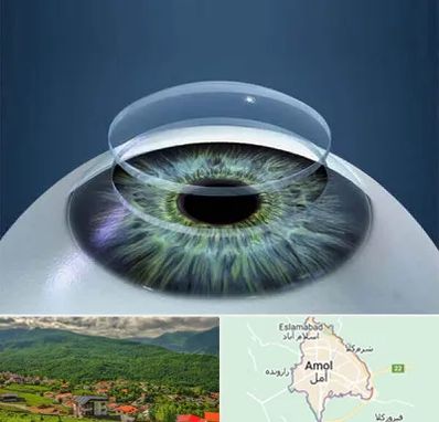 پیوند قرنیه در آمل