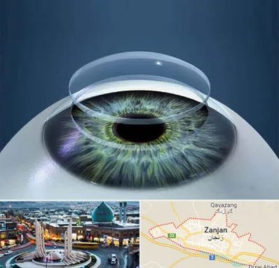 پیوند قرنیه در زنجان