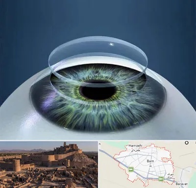 پیوند قرنیه در بم