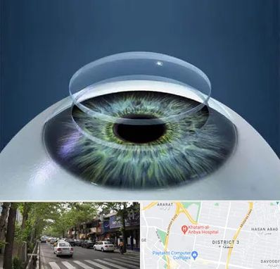 پیوند قرنیه در ظفر 