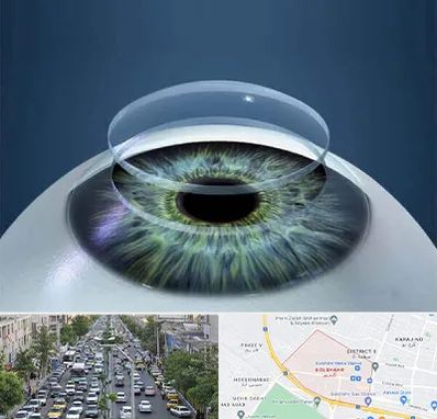 پیوند قرنیه در گلشهر کرج