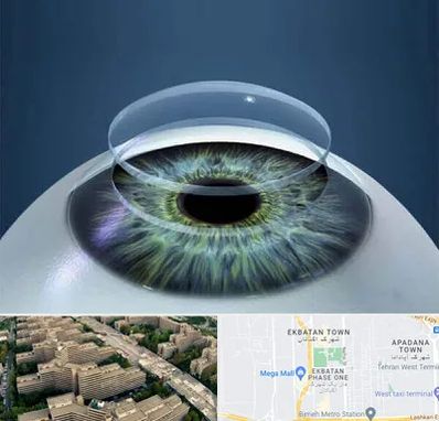 پیوند قرنیه در اکباتان 