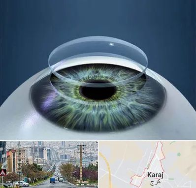 پیوند قرنیه در گوهردشت کرج 