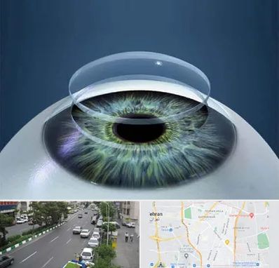 پیوند قرنیه در ستارخان 