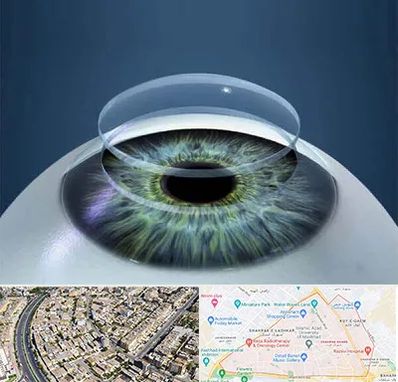 پیوند قرنیه در شهرک غرب مشهد