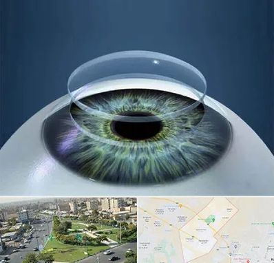 پیوند قرنیه در کمال شهر کرج 