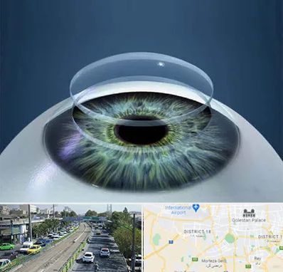 پیوند قرنیه در جنوب تهران 