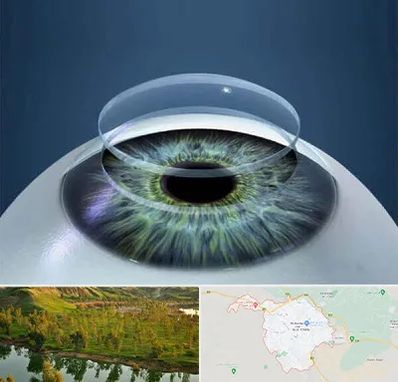 پیوند قرنیه در بهبهان