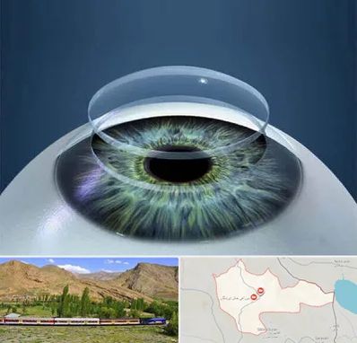 پیوند قرنیه در خاش