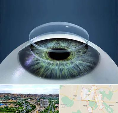 پیوند قرنیه در شهریار