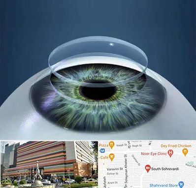 پیوند قرنیه در سهروردی 