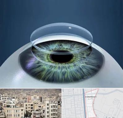 پیوند قرنیه در اسکندری