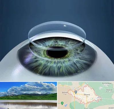 پیوند قرنیه در مرند