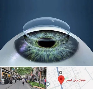پیوند قرنیه در ولیعصر شهریار