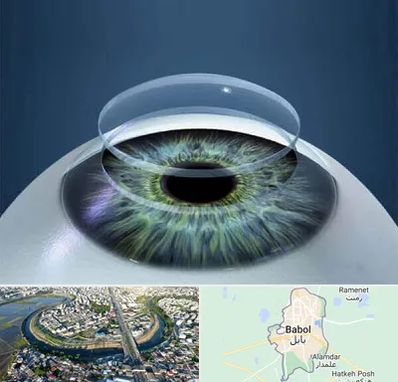 پیوند قرنیه در بابل