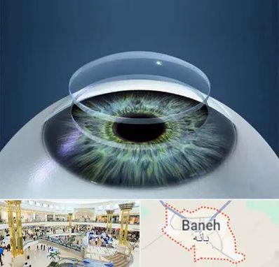 پیوند قرنیه در بانه