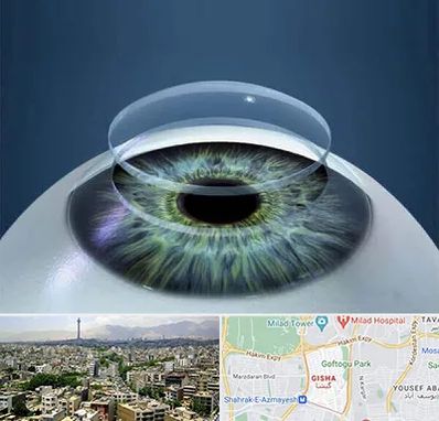 پیوند قرنیه در گیشا 