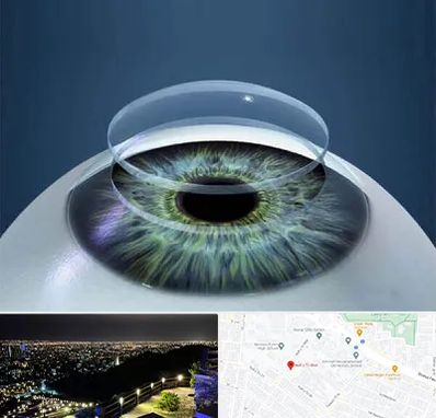 پیوند قرنیه در هفت تیر مشهد 