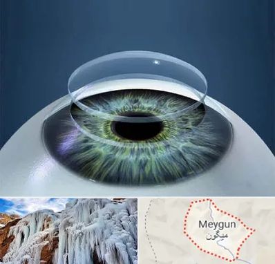 پیوند قرنیه در میگون