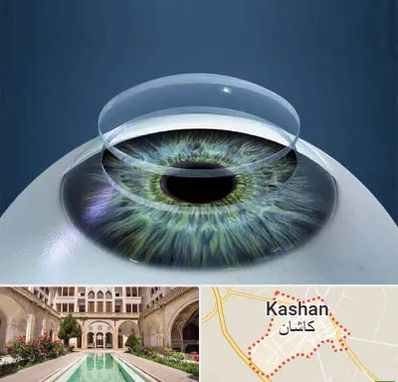 پیوند قرنیه در کاشان
