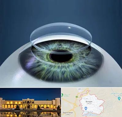 پیوند قرنیه در برازجان