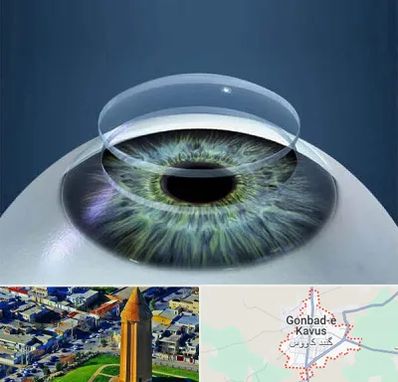 پیوند قرنیه در گنبد کاووس