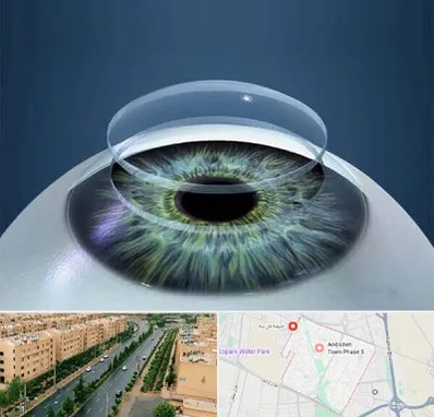 پیوند قرنیه در فاز سه اندیشه