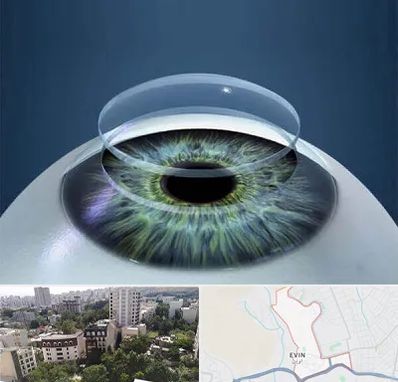 پیوند قرنیه در اوین