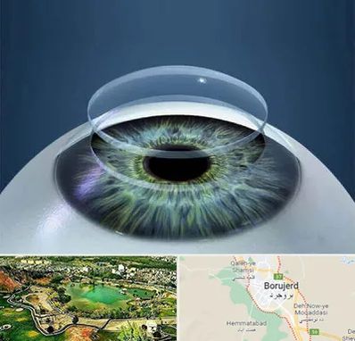 پیوند قرنیه در بروجرد