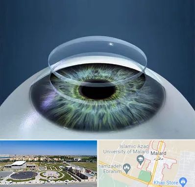 پیوند قرنیه در ملارد