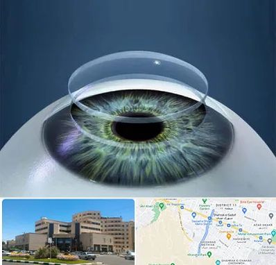 پیوند قرنیه در صیاد شیرازی مشهد