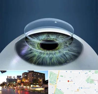 پیوند قرنیه در بلوار سجاد مشهد 