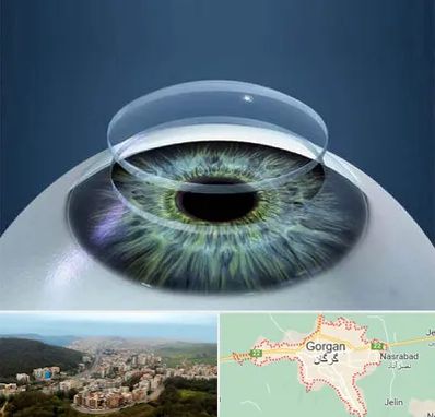 پیوند قرنیه در گرگان