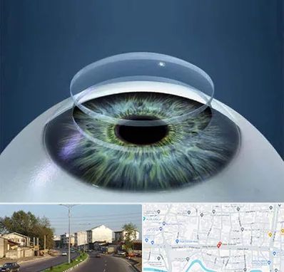 پیوند قرنیه در ضیابری رشت