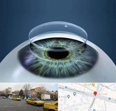 پیوند قرنیه در شهناز تبریز