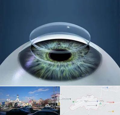 پیوند قرنیه در ماهدشت کرج 