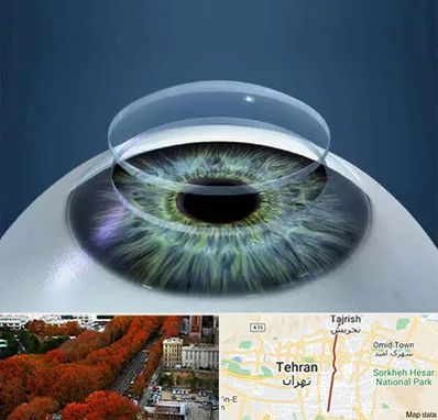 پیوند قرنیه در ولیعصر 