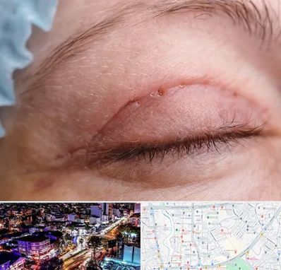 جراح پلک در منظریه رشت