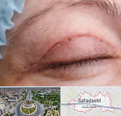 جراح پلک در صفادشت
