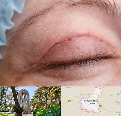 جراح پلک در نیشابور