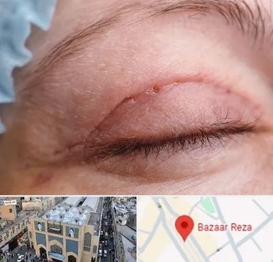 جراح پلک در بازار رضا مشهد