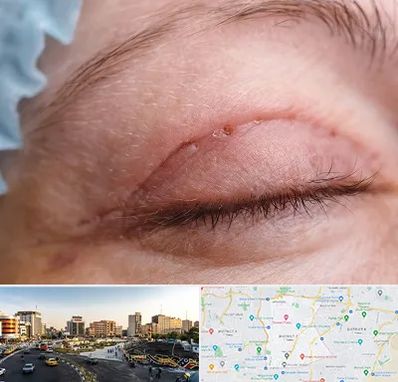 جراح پلک در منطقه 7 تهران 