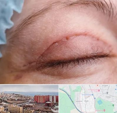 جراح پلک در سهند تبریز