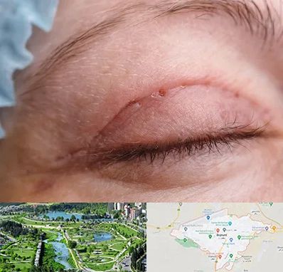 جراح پلک در بجنورد