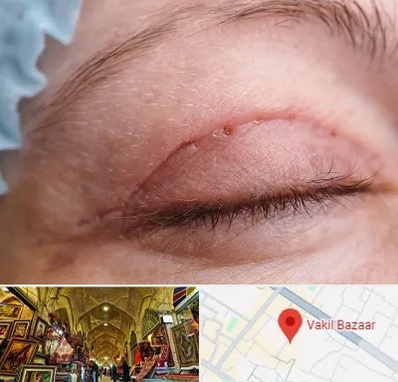 جراح پلک در بازار وکیل شیراز