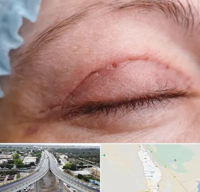 جراح پلک در اندیمشک