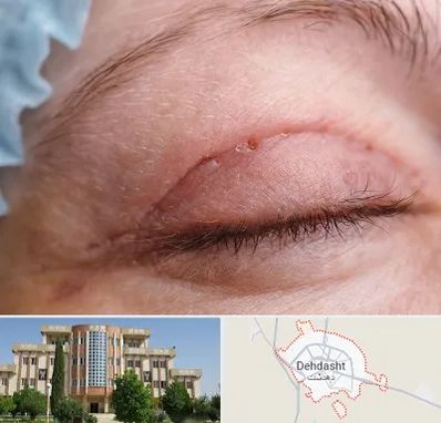 جراح پلک در دهدشت