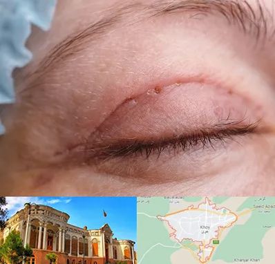 جراح پلک در خوی